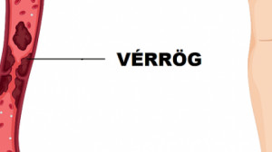 A vérrög 10 korai figyelmeztető jele, amit soha nem szabad figyelmen kívül hagyni
