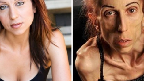 A 37 éves színésznő már alig 20 kilót nyomott! Képtelen volt kigyógyulni az anorexiából.