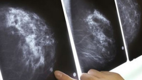 Egy orvos meglepő őszinteséggel beszélt a mammográfiáról. Minden nőnek el kellene olvasni.
