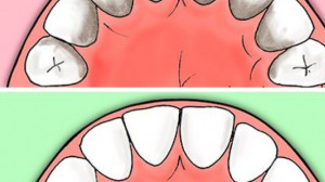 Egyszerű tipp, hogy megakadályozd a fogkőképződést, az ínybetegségeket és a szuvasodást