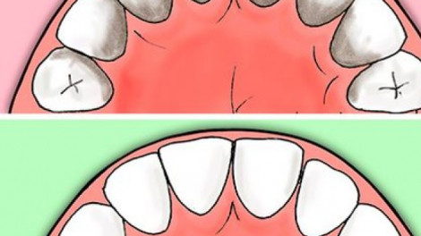 Egyszerű tipp, hogy megakadályozd a fogkőképződést, az ínybetegségeket és a szuvasodást