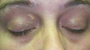 A szemhéj elszíneződése súlyos betegség veszélyére figyelmeztet!