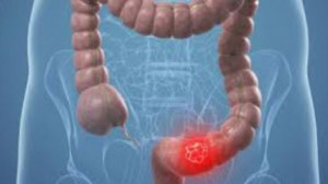 Székrekedésesek figyelmébe! Egy egyszerű módszerrel megoldódnak a gondjaid!